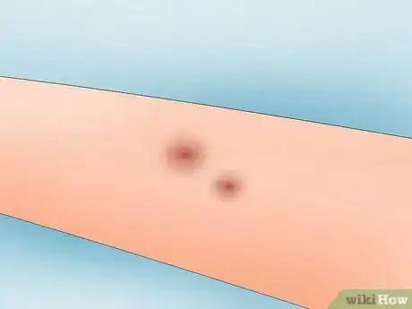 Image titled Get a Tick Head Out Step 7