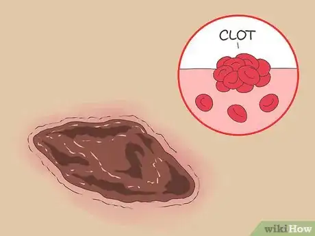 Image titled Know if a Wound Is Healing Step 6