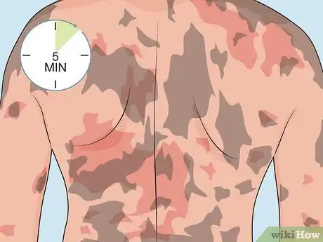 Image titled Control Psoriasis Step 06