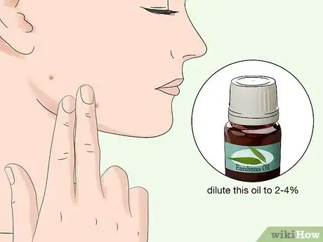 Image titled Use Herbs to Treat Acne Step 5