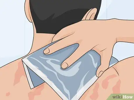 Image titled Control Psoriasis Step 01