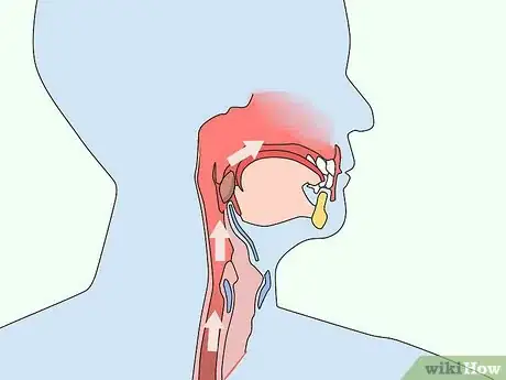 Image titled Diagnose Esophageal Diverticulum Step 4