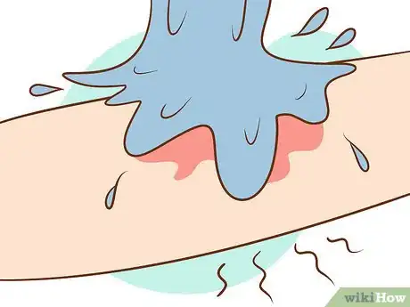 Image titled Get Rid of Poison Ivy Step 11