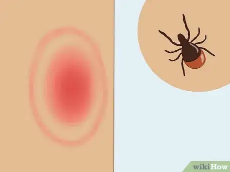 Image titled Treat Mast Cell Activation Syndrome Step 4