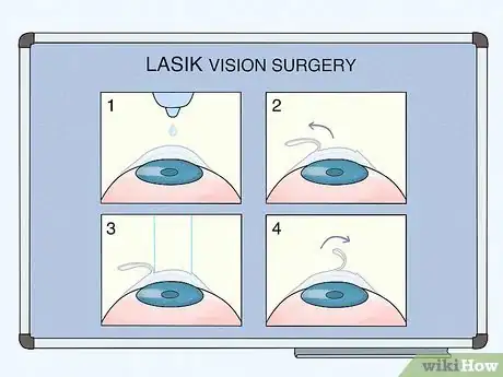 Image titled Know if Laser Vision Surgery Is Right for You Step 8