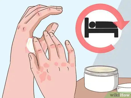 Image titled Sleep Better when You Have Psoriasis Step 10