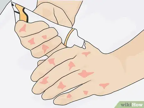 Image titled Help Control Psoriasis with Lifestyle Changes Step 16
