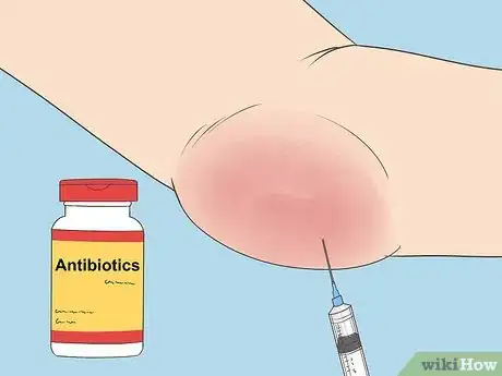 Image titled Diagnose Bursitis Step 14