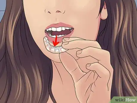 Image titled Get Straight Teeth Without Braces with Invisalign Step 12