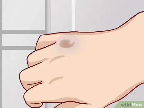 Image titled Know If Your Knuckle Is Broken Step 7
