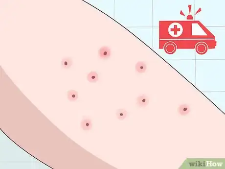 Image titled Prevent Folliculitis Step 16