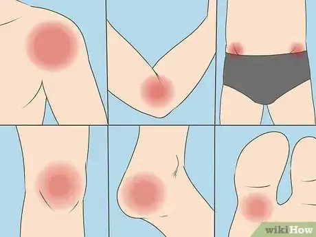 Image titled Diagnose Bursitis Step 2