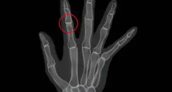 Use Aloe Vera to Treat Rheumatoid Arthritis