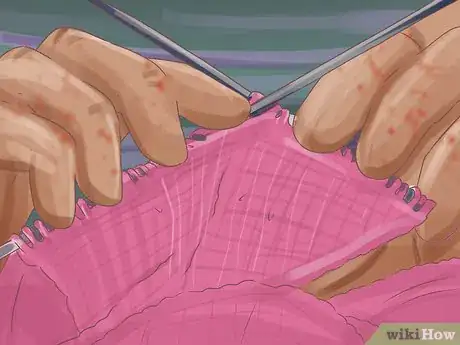 Image titled Stop Dermatillomania Step 15