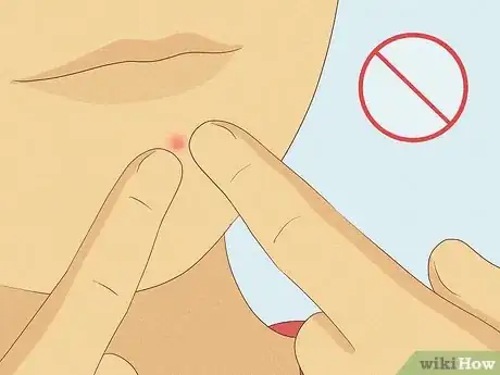 Image titled Clean Your Face to Prevent Pimples Step 25