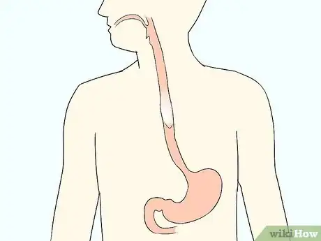 Image titled Diagnose Esophageal Diverticulum Step 8