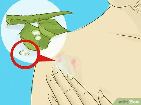 Image titled Use Aloe Vera to Treat Burns Step 7