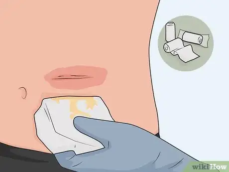 Image titled Heal Quickly After a Hysterectomy Step 13