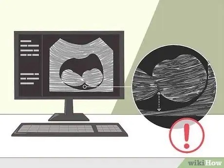 Image titled Detect Chromosomal Abnormalities Step 2