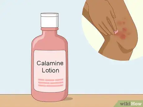 Image titled Soothe Itchy Legs Step 18