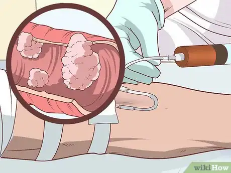 Image titled Treat Colon Cancer Step 5