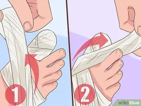 Image titled Treat a Torn Toenail Step 5