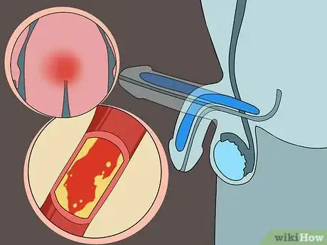 Image titled Diagnose Sexual Dysfunction Disorder Step 13