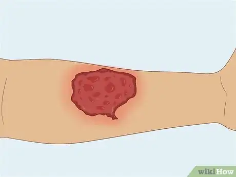 Image titled Treat Hypocalcemia Step 5