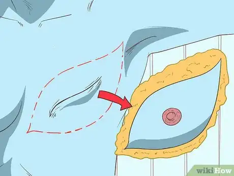 Image titled Treat Breast and Extramammary Paget's Disease Step 2