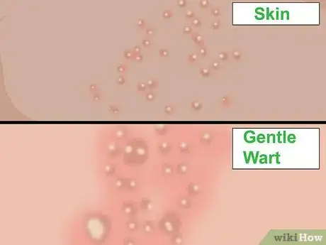 Image titled Get Rid of Fordyce Spots Step 11