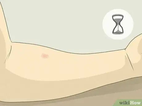 Image titled Test for Tuberculosis Step 3