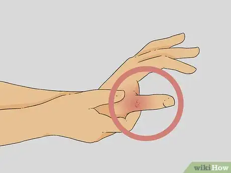 Image titled Diagnose a Broken Thumb Step 2