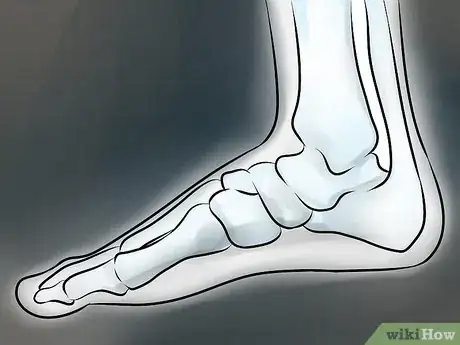 Image titled Recognize Plantar Fasciitis Symptoms Step 12