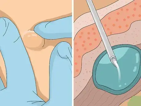 Image titled Get Muscle Tears Surgically Removed Step 5