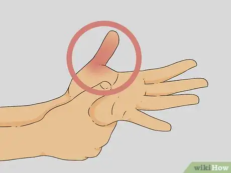 Image titled Diagnose a Broken Thumb Step 5