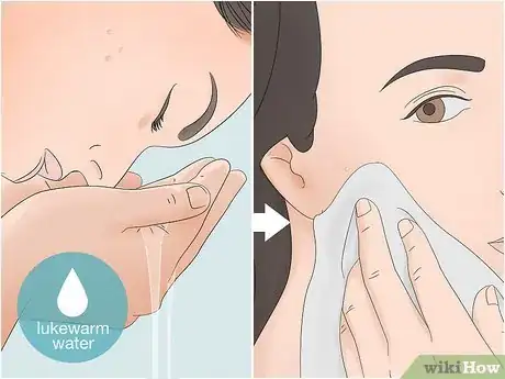 Image titled Clear Pustules on Your Face Step 3