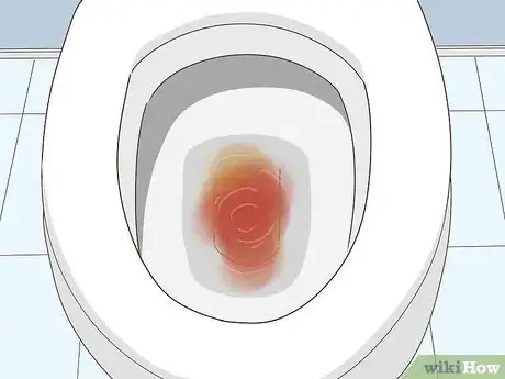 Image titled Diagnose Bladder Cancer Step 1