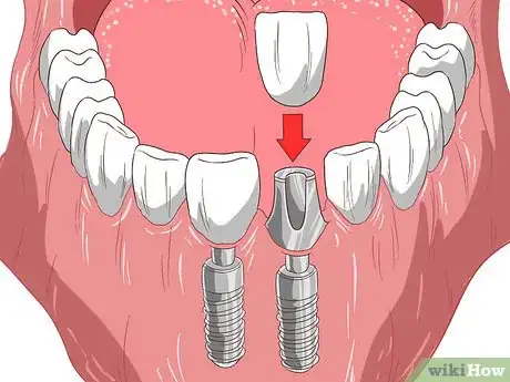 Image titled Straighten Your Teeth Without Braces Step 4