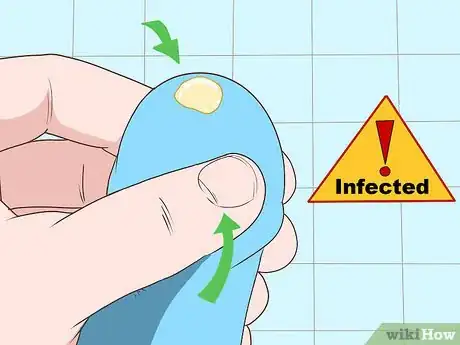 Image titled Treat NGU Step 6