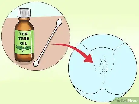 Image titled Stop Vaginal Itching Step 7