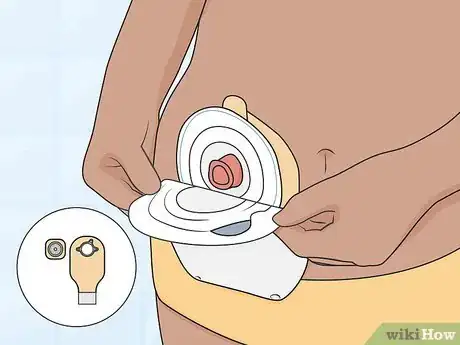 Image titled Get Used to an Ostomy Step 13