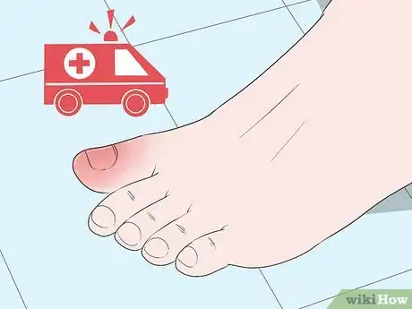 Image titled Heal a Bruised Toe Step 12