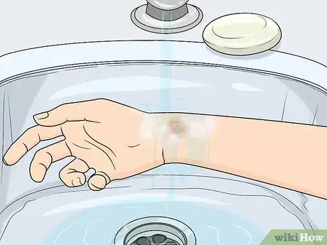 Image titled Treat Insect Bites in Toddlers Step 1