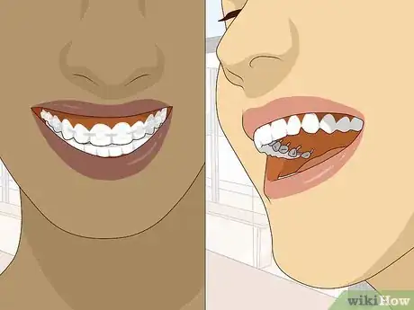 Image titled Wear Braces With Confidence and Style Step 4