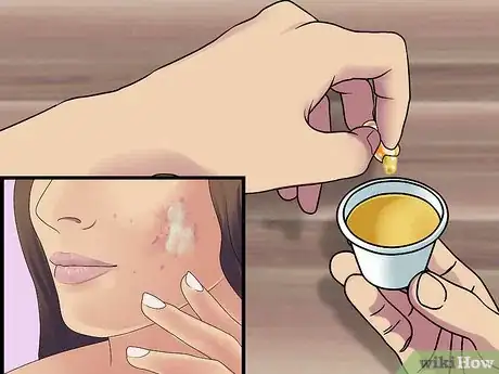 Image titled Get Rid of Cystic Acne Scars Step 4