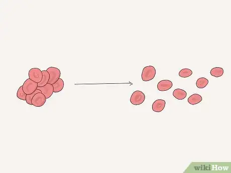 Image titled Diagnose and Treat Thrombophilia Step 5