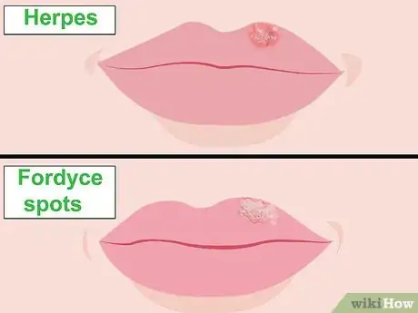 Image titled Get Rid of Fordyce Spots Step 10