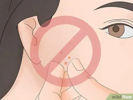 Image titled Clear Pustules on Your Face Step 6