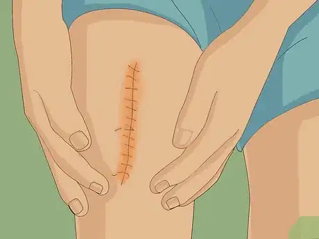 Image titled Get Muscle Tears Surgically Removed Step 4