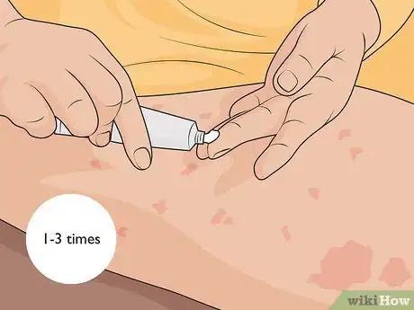 Image titled Control Psoriasis Step 02